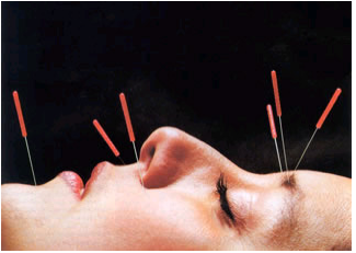 Gingkoacupuncture.blogspot.com
